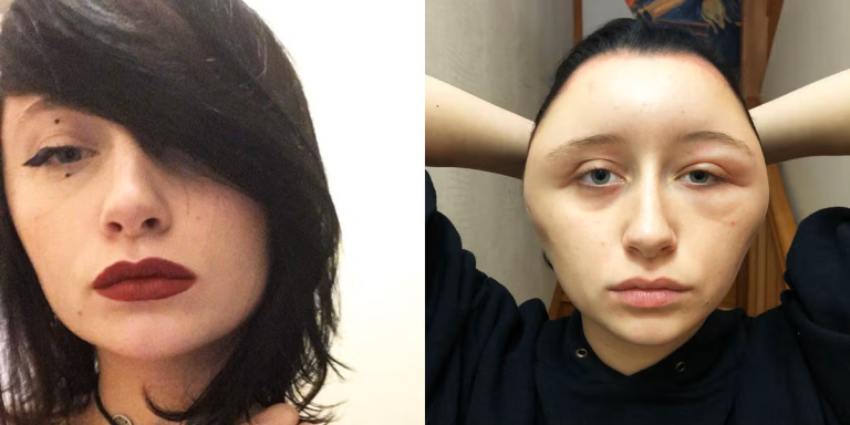 Severe Hair Dye Reaction: A Cautionary Tale