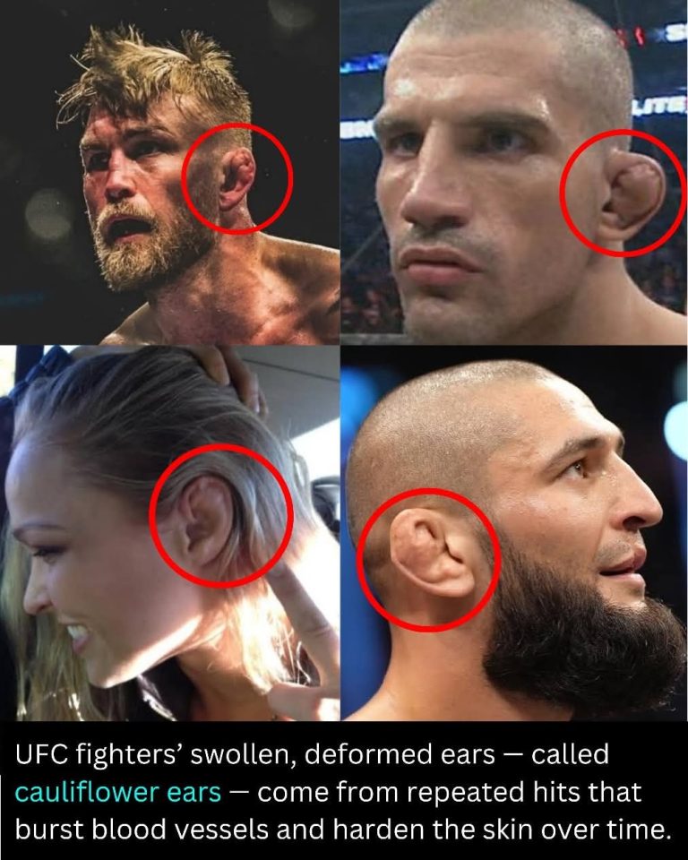 The Price of Every Punch: The Story Behind UFC Fighters’ “Cauliflower Ears”