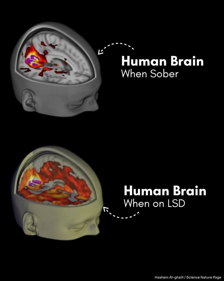 What the human brain looks like on LSD
